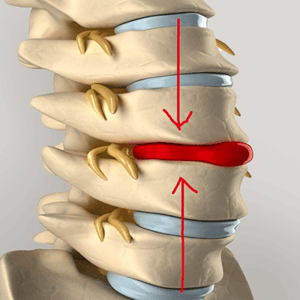 межпозвонковая грыжа